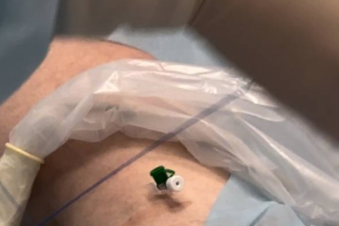 Результаты лечения варикоза &mdash; фото до и после